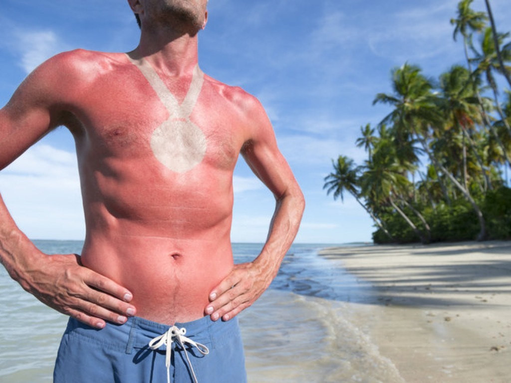 What Sunburn Actually Does to your Body