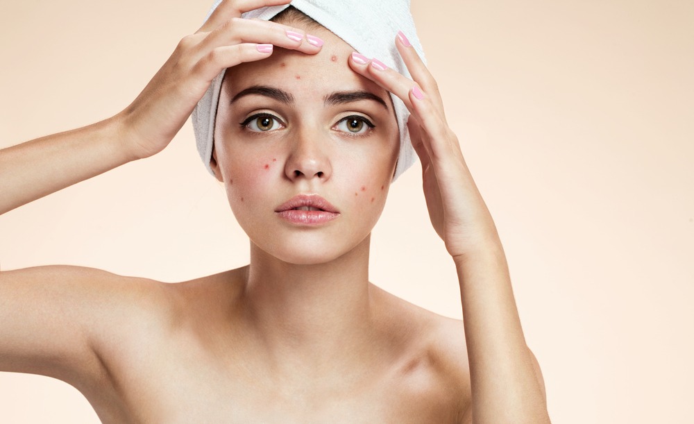 These Are The Best Remedies To Get Rid of Acne