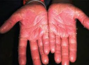 Kawasaki diseases makes your palms red and peeling