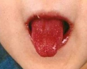 Kawasaki diseases makes your tongue red and lips dry