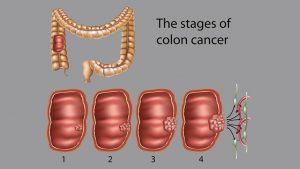 The stage of colon cancer
