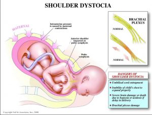 Shoulder Dystocia